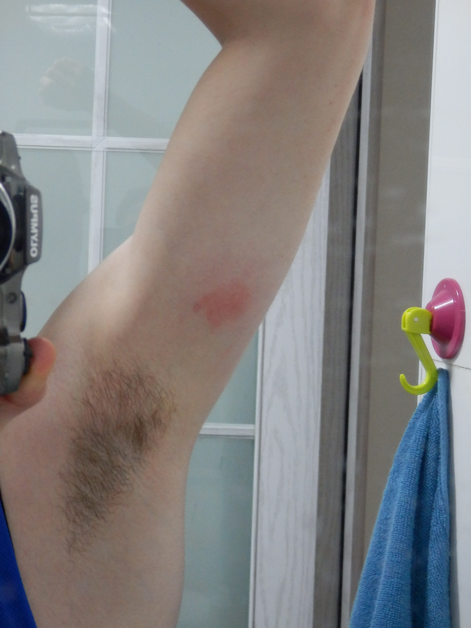 Bug Bites Back Home Have Nothing on Bug Bites Here :(